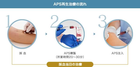 APS再生治療の流れ: 1.採 血 / 2.APS精製（所要時間20〜30分） / 3.APS注入 | 採血当日の治療