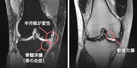 Mri検査で整形外科専門医が即日診断 大阪ひざ関節症クリニック