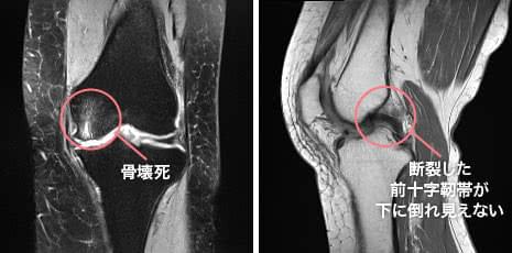 大腿骨内側の骨壊死と前十字靭帯断裂が認められたMRI画像