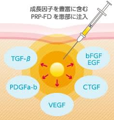 PRP-FDに豊富に含まれる、さまざまな成長因子