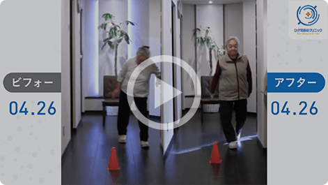 患者様の治療前後の歩行比較動画1