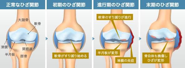 正常なひざ関節 | 初期のひざ関節: 軟骨がすり減り始める | 中期のひざ関節: 軟骨がすり減りが進行 / 半月板が変形 / 滑膜の炎症 | 末期のひざ関節: 骨自体も損傷しひざが変形