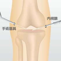 関節鏡視下手術（デブリドマン手術）: ひざに２、３カ所つくった６mmほどの小さな切開口から内視鏡（カメラが搭載された細い棒状の器具）を挿入し、関節内をモニターで見ながら行う手術です。