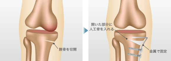 脛骨を切開 / 開いた部分に人工骨を入れる 金属で固定