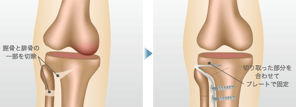 脛骨と腓骨の一部を切除 / 切り取った部分を合わせてプレートで固定