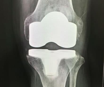 人工ひざ関節置換術後のレントゲン画像
