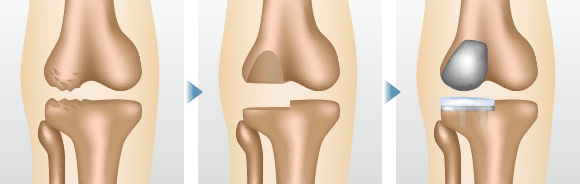 ひざ関節の内側だけ、もしくは外側だけなど、損傷が激しい部分だけを人工関節に置き換える方法