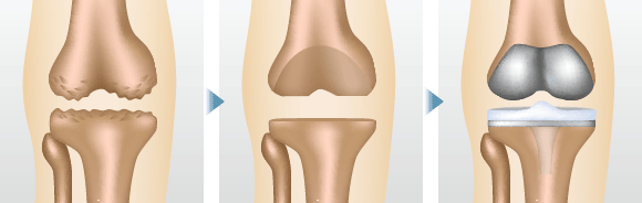 ひざ関節全体を人工関節に置き換える手術